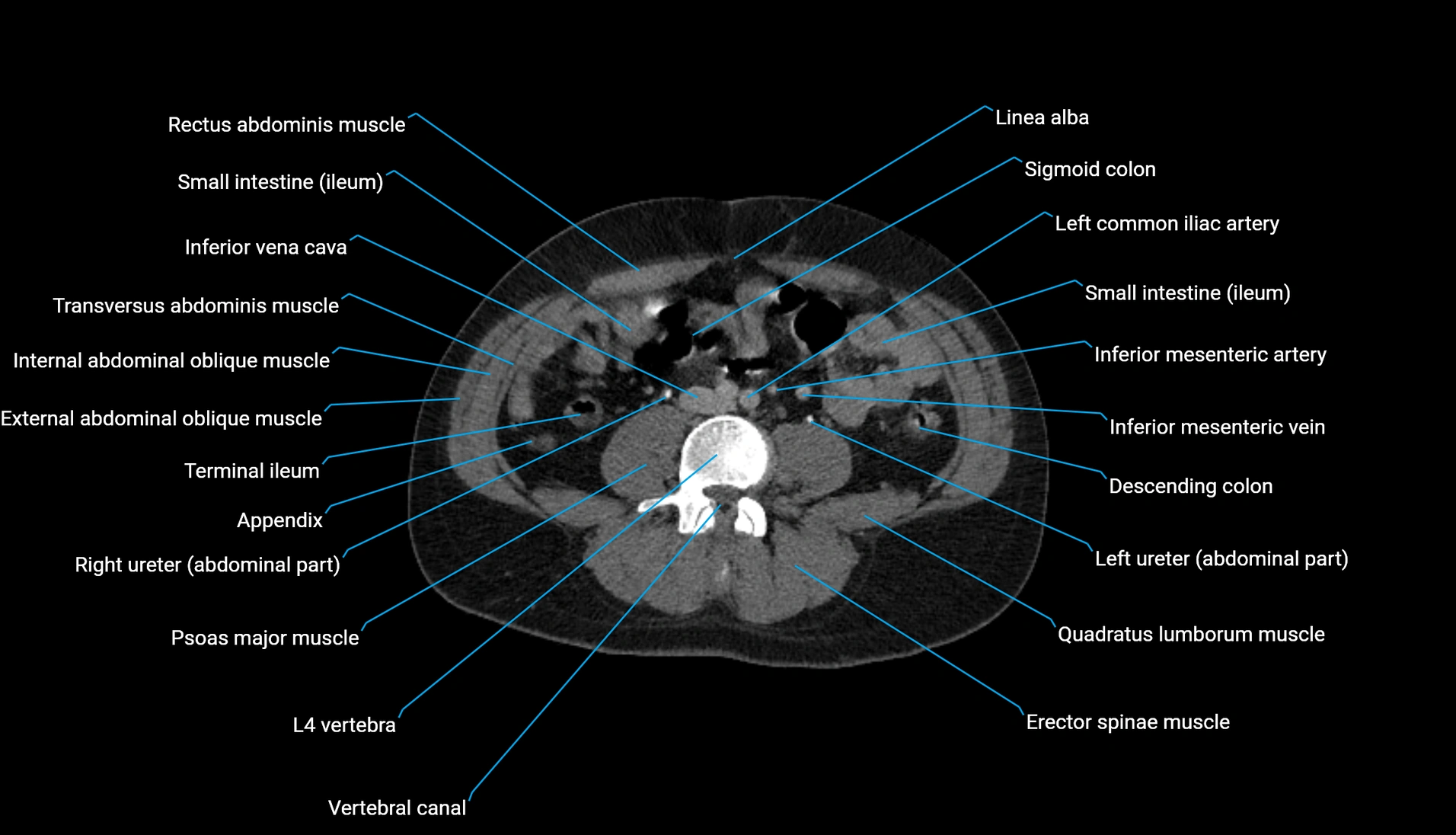 CT urogram axial cross sectional anatomy  labelled radiology image-00147.webp